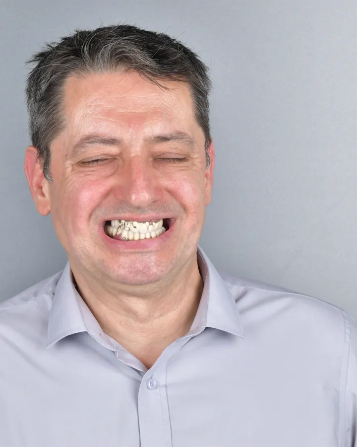 Înainte de tratamentul implantar