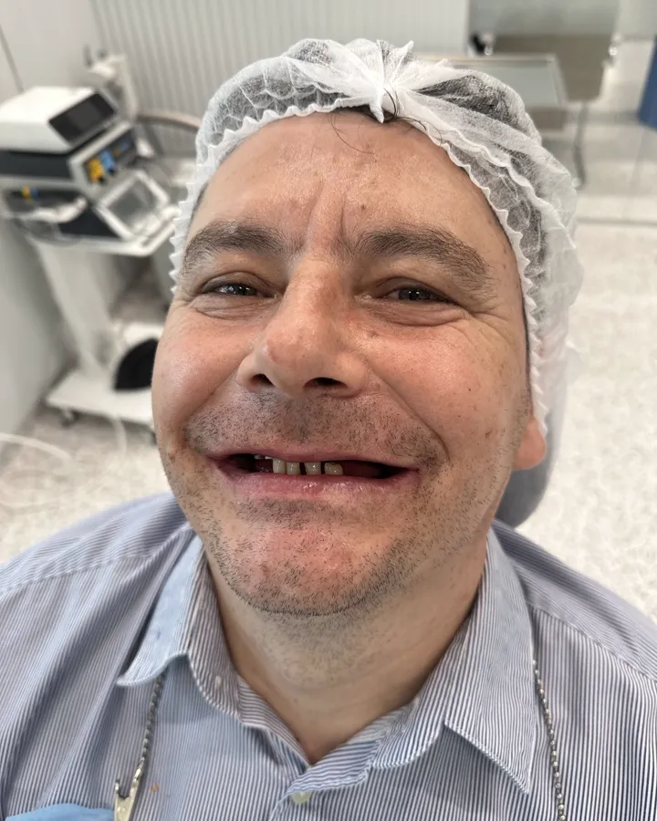 Înainte de tratamentul implantar