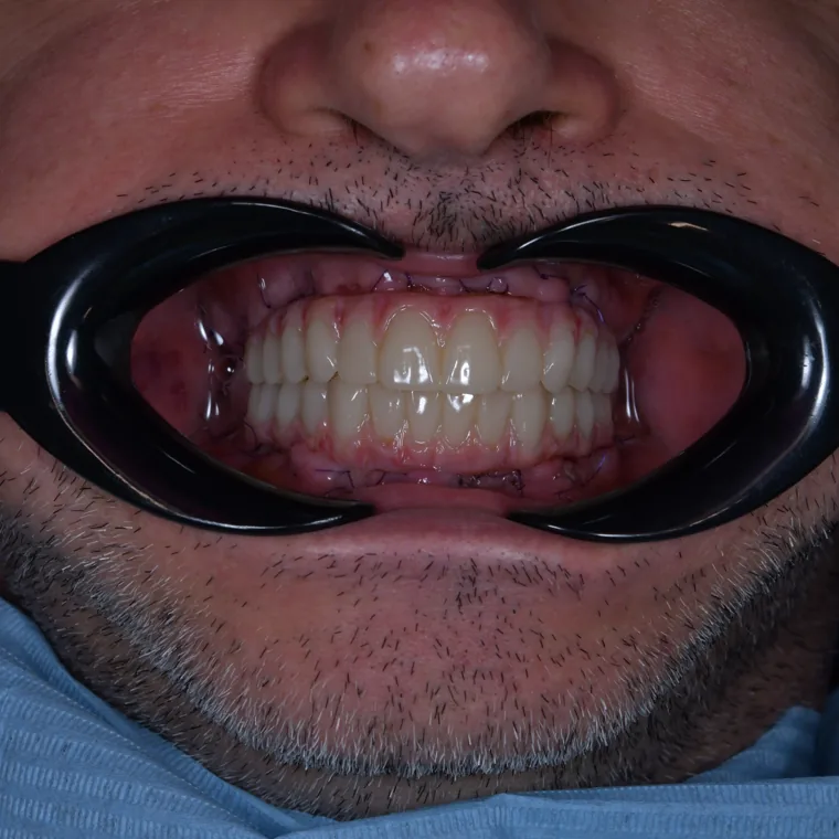 După tratamentul implantar