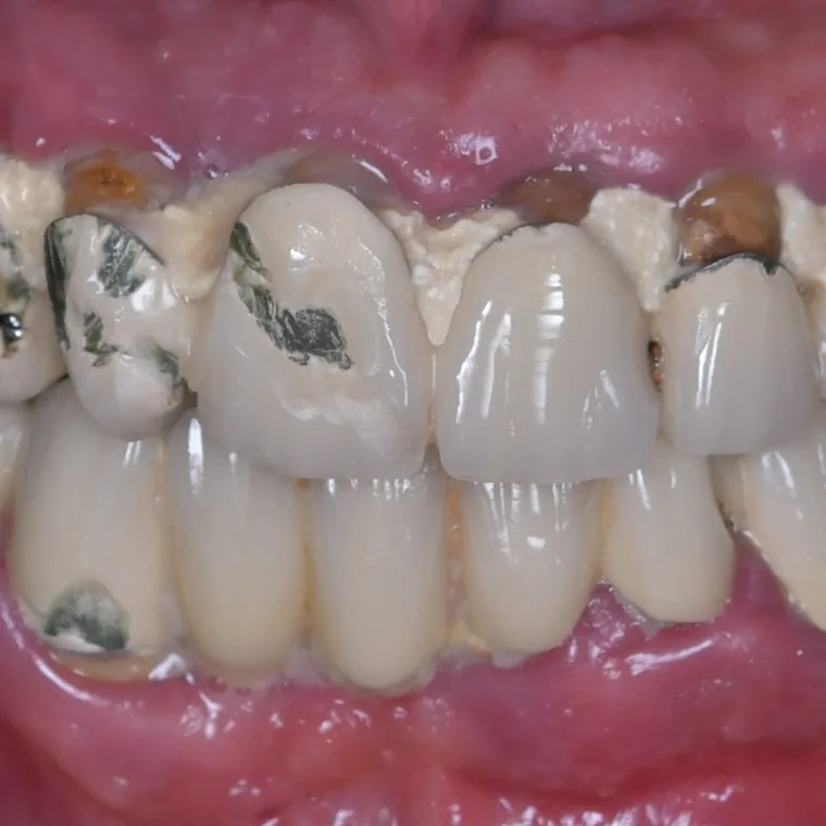 Înainte de tratamentul implantar