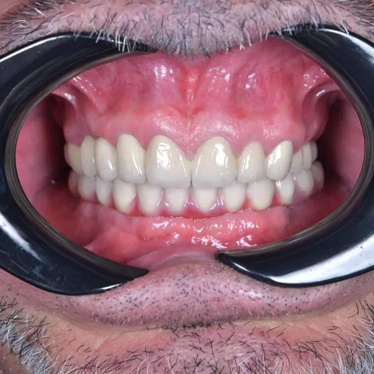 După tratamentul implantar