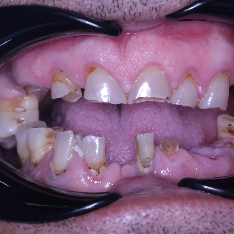 Înainte de tratamentul implantar