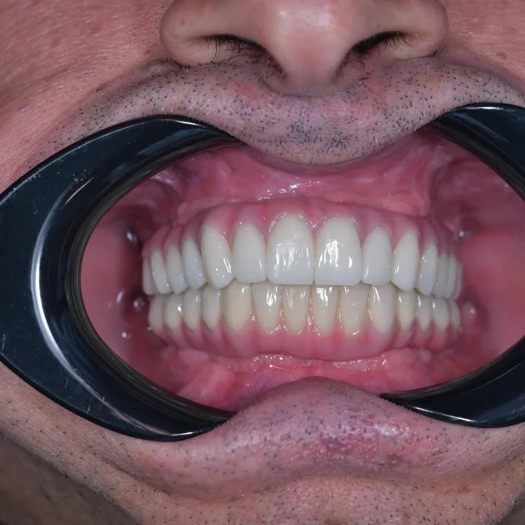 Arcadă dentară după dinți ficși în 24h pe implanturi, NeoSmile Iași și Roman