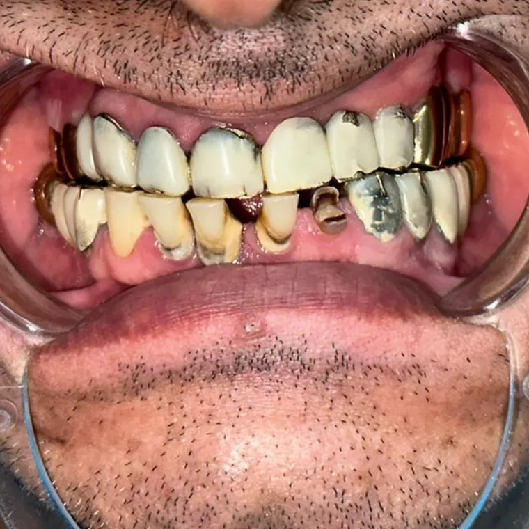 Arcadă dentară înainte de dinți ficși, dinți deteriorați, NeoSmile Iași